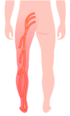 sciatique hernie discale osteo argenteuil