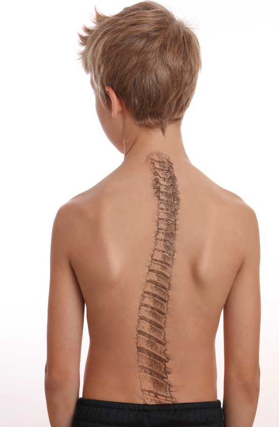 scoliose enfant dos osteo 95