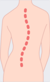 scoliose douleur asymetrie osteo 95