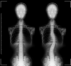 scoliose enfant dos osteo 95