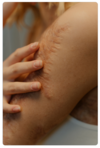 cicatrice douleur osteo argenteuil