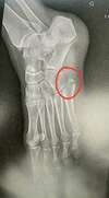 radio cheville fracture