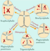 qu'est ce qu'une craniostenose